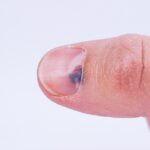 Jak usunąć krwiaka podpaznokciowego? Jak usunąć krwiaka podpaznokciowego?